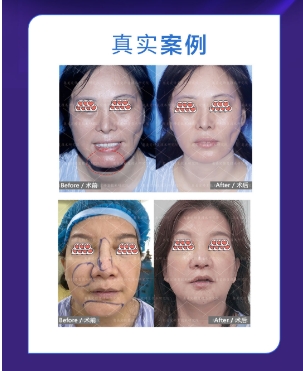 馒化修复是否会皮肉分离